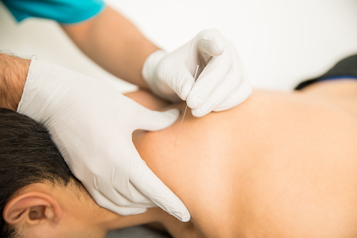 Things to Know About Dry Needling