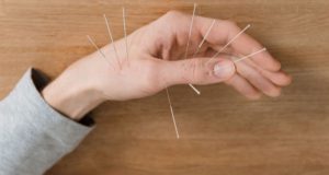 2 Acupuncture Treatment Overview