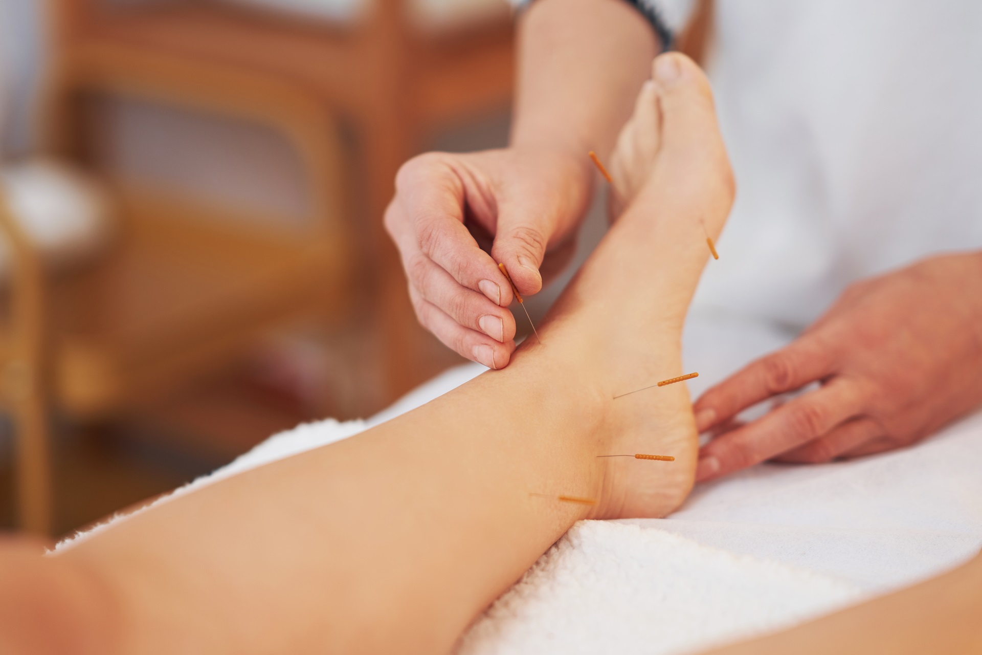 Exploring the Benefits of Acupuncture for Pain Management