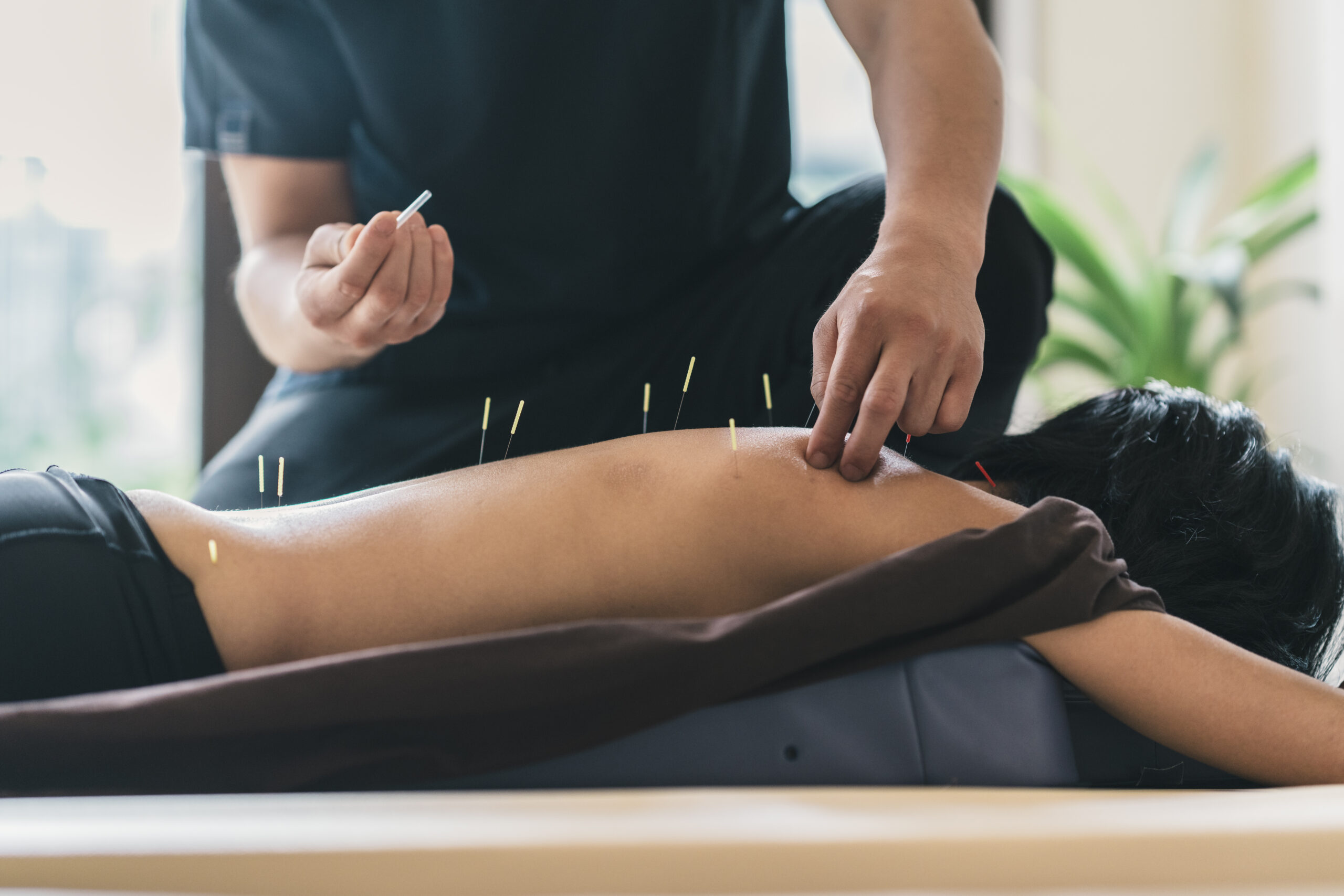 How Acupuncture in Langley Promotes Healing